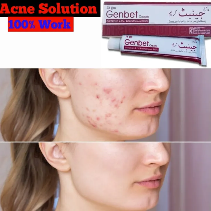 Genbet%20Cream%20for%20Acne%20-%20Image%203