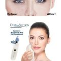 Blackhead Removal Machine Derma Suction 4 In 1 Black Head Remover Machine | Blackhead Removal Machine 4 In 1 Pore Cleaner Tool | Derma Suction Black Head | Blackhead Removal Derma Suction Machine | Derma Suction | Derma Suction Machine. 
