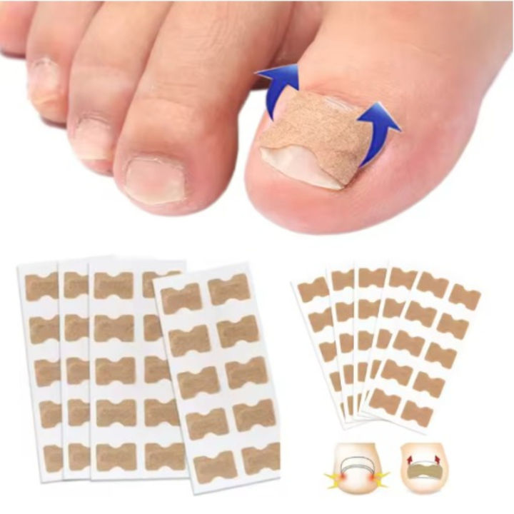 professional%20Nail%20Correction%20Stickers%20Ingrown%20Toenail%20Corrector%20Patches%20Paronychia%20Treatment%20Recover%20Corrector%20Pedicure%20Tools%20-%20Image%206