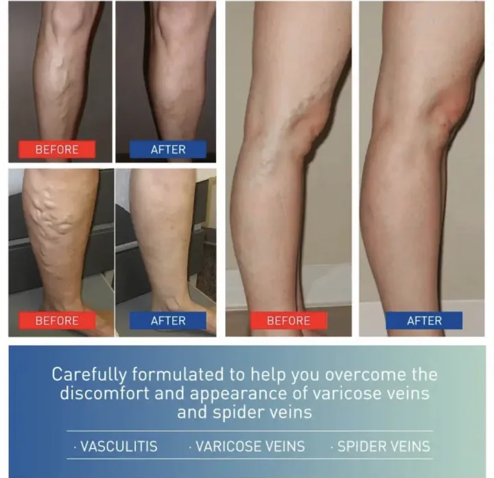 ointment%20for%20varicose%20veins%20Effective%20varicose%20vein%20relief%20cream%20to%20relieve%20Leg%20vasculitis%20phlebitis%20spider%20pain%20swelling%20Care%20-%20Image%202