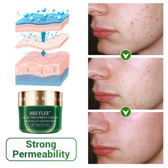 Breylee%20Salicylic%20skin%20care%20product%20Acid%20Acne%20Face%20Wash%20-%20100g%20(%20imported%20100%20%25%20Authentic%20product%20)%20-%20Image%204