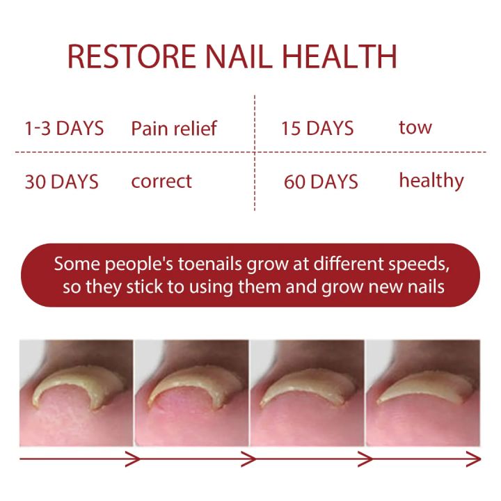 German%20ToenailPlus%E2%84%A2%20Anti%20Paronychia%20Relief%20Oil%20-%2010ML%20-%20Image%204