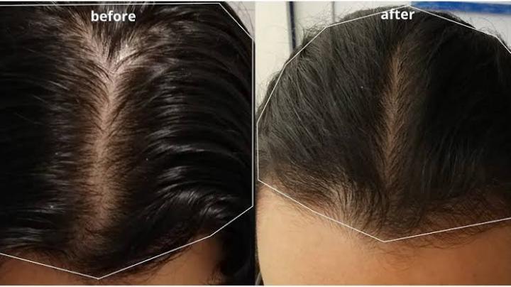 Minoxidil%205%25%20Hair%20Topical%20Solution%20Hairfall%20Solution%20Hair%20Regrowth%20-%20Minoxin%20spray%20-%20Image%206