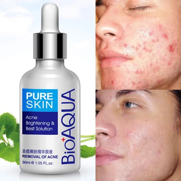 Bioaqua%20Anti-Acne%20Serum%20Removal%20Of%20Acne%20Essence%20Liquid%2030ML%20-%20Image%205