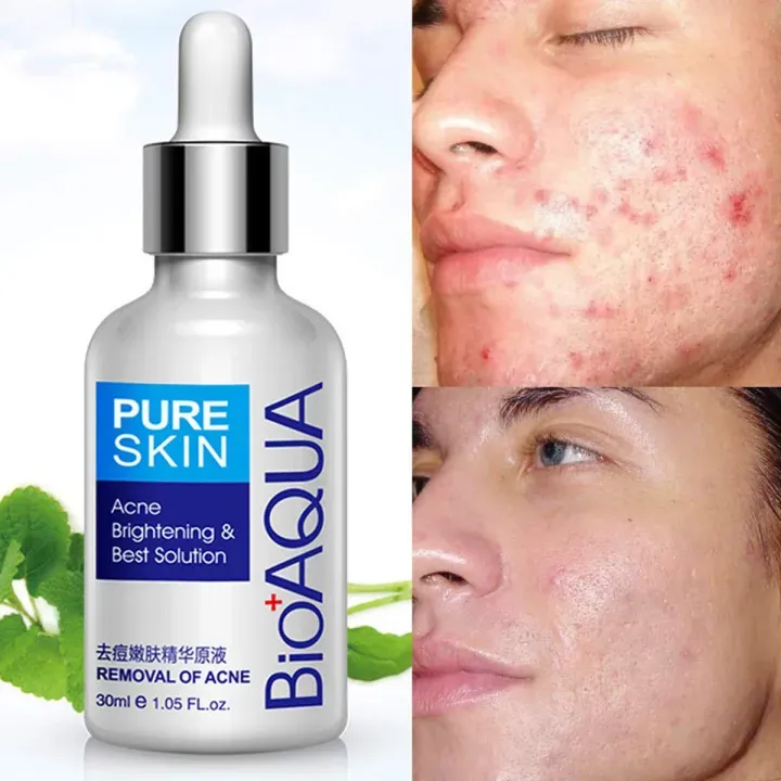 Bioaqua%20Anti-Acne%20Serum%20Removal%20Of%20Acne%20Essence%20Liquid%2030ML%20-%20Image%205