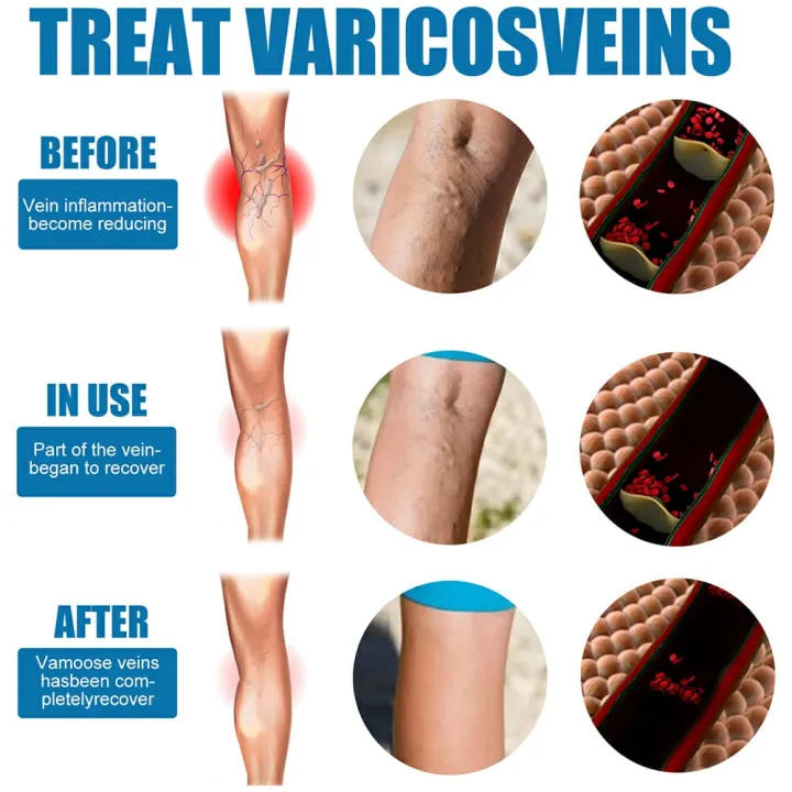 South%20Moon%20Varicose%20Veins%20Treatment%20Spray%20%7C%20Advanced%20Solution%20for%20Spider%20Veins,%20Leg%20Pain%20&%20Swelling%20Relief%20-%20Image%207