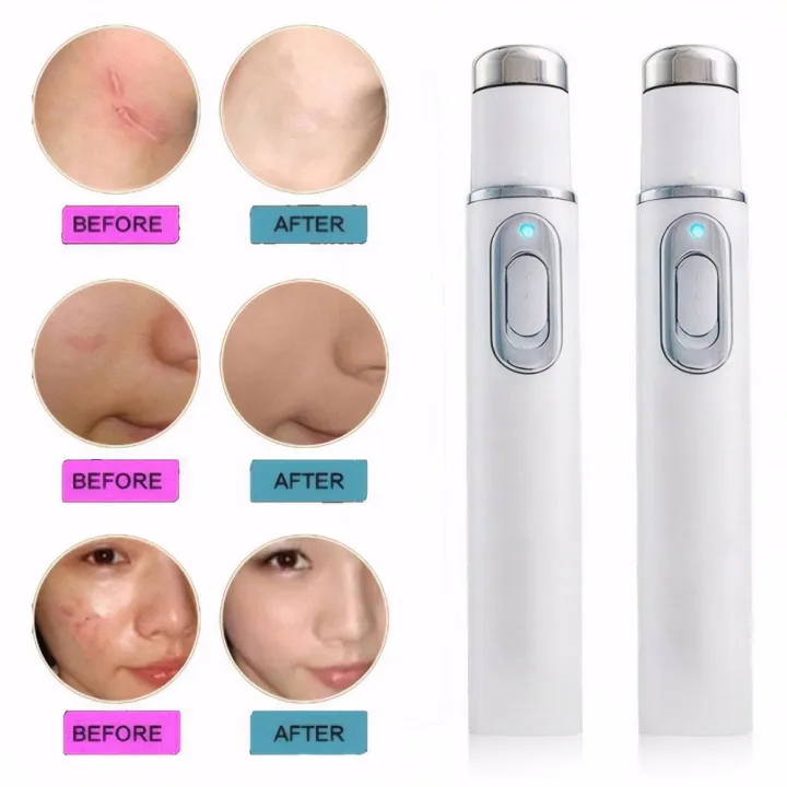 1pc%20Acne%20Wrinkle%20Removal%20Laser%20Pen%20Skin%20Spots%20Removal%20Anti%20Varicose%20Spider%20Vein%20Treatment%20Medical%20Blue%20Light%20Eye%20Massage%20Instrum%20-%20Image%205