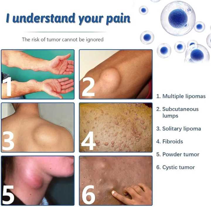 South%20Moon%20Lipoma%20Removal%20&%20Body%20Smoothing%20Cream%20-%2050g%20-%20Herbal%20Natural%20Lump%20&%20Skin%20Knot%20Relief%20Ointment%20for%20Neck%20&%20Body%20-%20Image%205