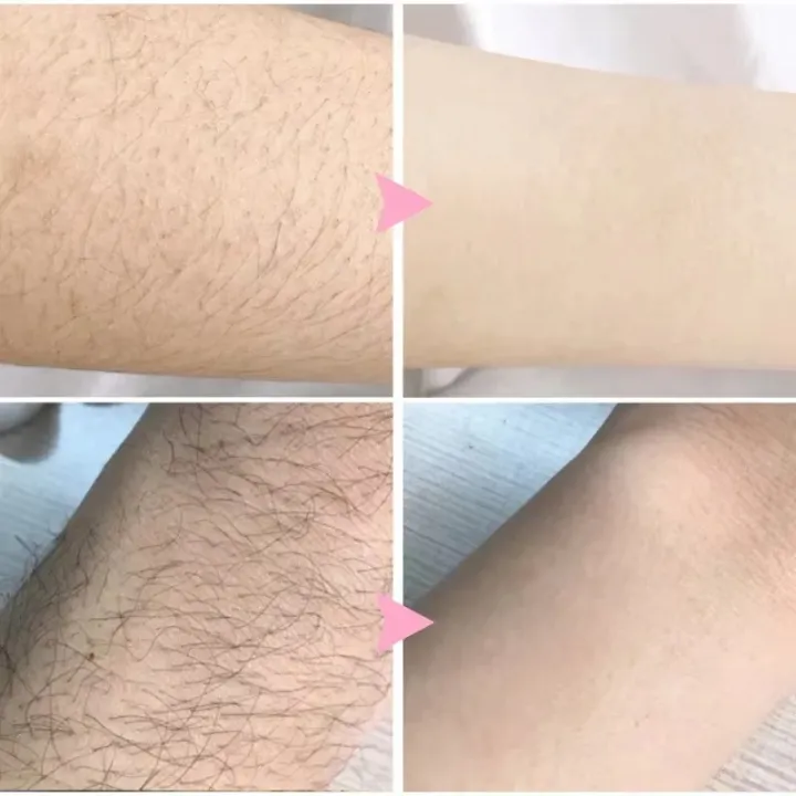 2%20Minutes%20Painless%20Fast%20Hair%20Removal%20Spray%20Hair%20Growth%20Inhibitor%20Arm%20Armpit%20Leg%20Permanent%20Depilatory%20for%20Men%20Women%20Repair%20Care%20-%20Image%204