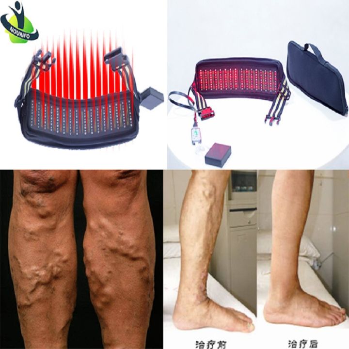 Successful%20treatment%20of%20diabetic%20foot%20ulcers%20with%20low-level%20laser%20therapy%20-%20Image%202