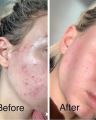 Cerave SA Renewing Cleanser for Normal Skin – 237ml | Gentle Exfoliating Face & Body Wash. 