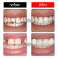 10/30ML Resin Tooth Repair Glue Shapeable Teeth Gaps Filling Solid Temporary Teeth Repair Falseteeth Glue Safety Broken Fangs. 