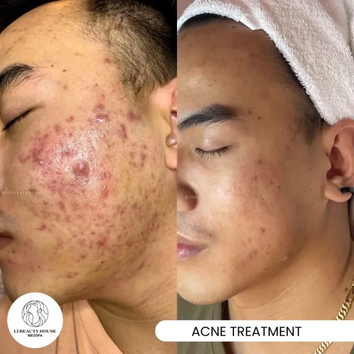 T3%20mycin%20lotion%20-%20Image%205