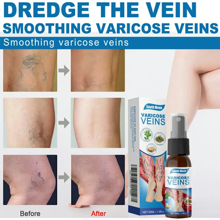 South%20Moon%20Varicose%20Veins%20Treatment%20Spray%20%7C%20Advanced%20Solution%20for%20Spider%20Veins,%20Leg%20Pain%20&%20Swelling%20Relief%20-%20Image%208
