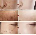 White Rice Face Whitening Cream Remove Dark Spots Fade Freckle Melanin Anti Wrinkle Aging Moisturizing Brighten Skin Care. 