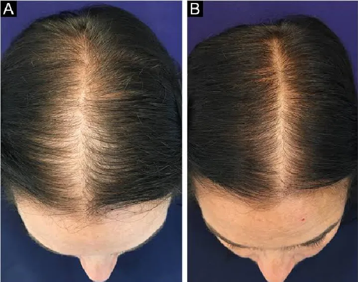 Minoxin%20Plus%20Topical%20Hair%20Regrowth%20Solution%20(Minoxidil%205%25),%2060ml%20-%20Brookes%20Pharma%20-%20Image%205