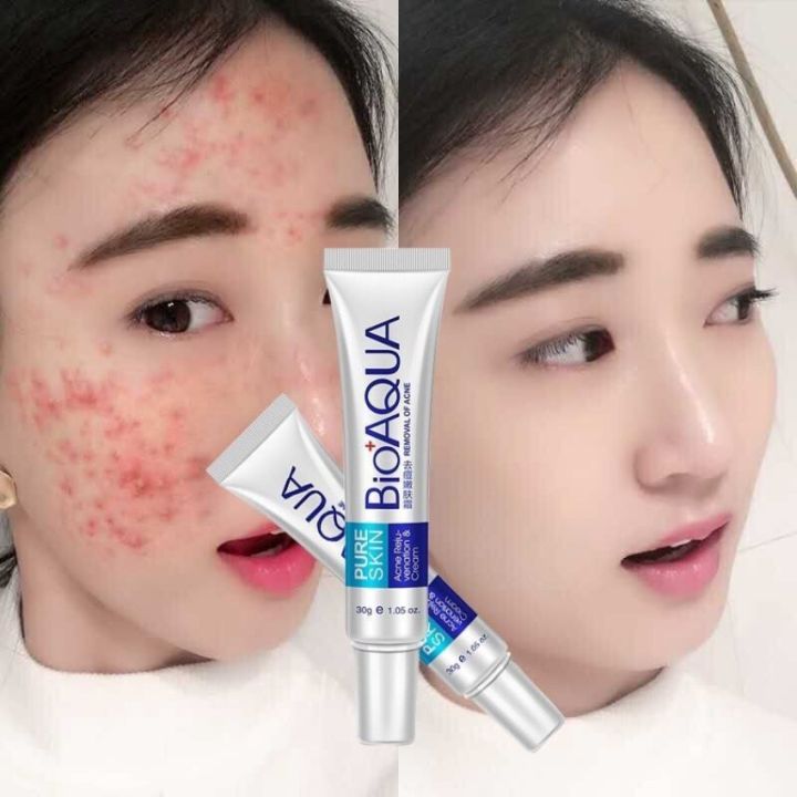 BIOAQUA Pure Skin Acne Removal and Rejuvenation Cream - 30g | Daraz.com.bd