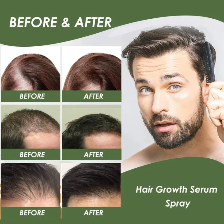 7%20Day%20Ginger%20Hair%20Growth%20Essence%20Germinal%20Serum%20Essence%20Oil%20Natural%20Hair%20Loss%20Treatement%20Effective%20Fast%20Growth%20Hair%20Care%20-50ML%20-%20Image%209