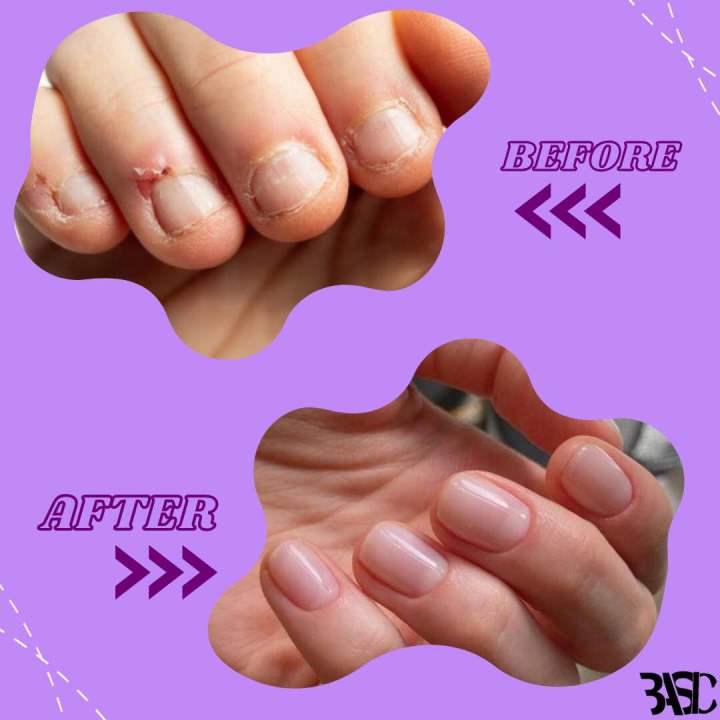 Nail%20Biting%20Stop%20Serum%20%7C%20Anti-Nail%20Biting%20Serum%20%7C%205ml%20%7C%20100%25%20Safe%20for%20Kids%20&%20Adults%20%7C%20Helps%20to%20lose%20nail%20biting%20habit%20%7C%20100%25%20made%20with%20natural%20&%20organic%20oils%20%7C%20No%20chemicals%20%7C%20Guaranteed%20results%20with%202-3%20months%20of%20use%20%7C%20use%20consistently%20-%20Image%204