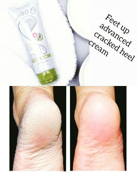 "Feet%20Up%20Advanced%20Cracked%20Heel%20Repair%20Cream%20by%20Oriflame"%20-%20Image%203
