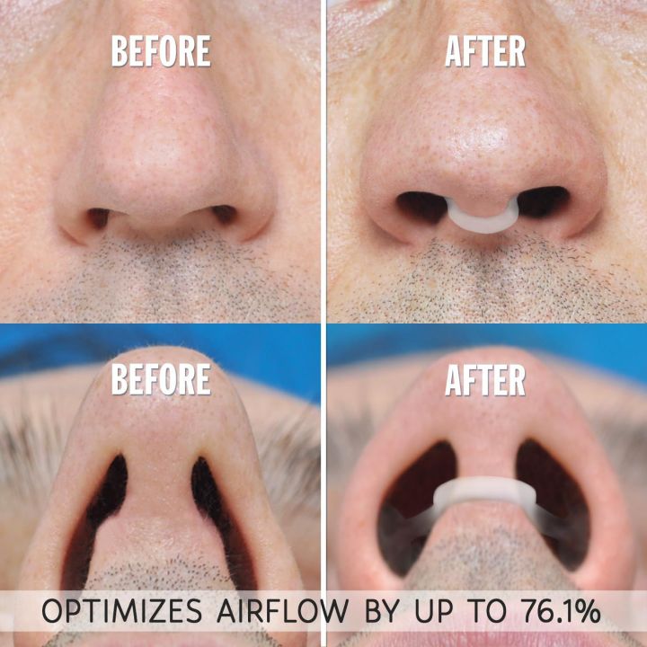Anti%20Snoring%20Device%20To%20Stop%20Snoring%20Nose%20Clip%20For%20Easy%20-%20Image%203