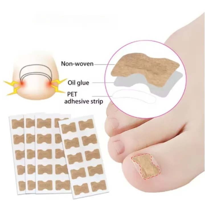 professional%20Nail%20Correction%20Stickers%20Ingrown%20Toenail%20Corrector%20Patches%20Paronychia%20Treatment%20Recover%20Corrector%20Pedicure%20Tools%20-%20Image%205