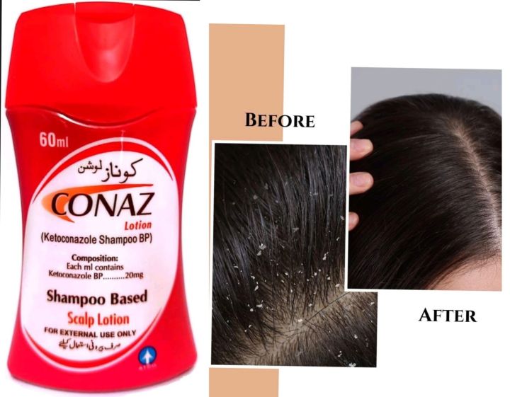 Conaz%20Shampoo%20Based%20Lotion%20For%20Dandruff%20free%20scalp%20-%20Image%202
