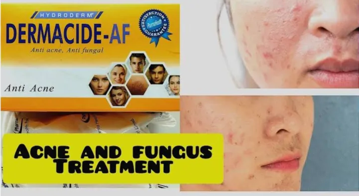 Dermacide_AF%20anti%20acni%20anty%20fungal%20soap%20for%20Man%20&%20womans%20-%20Image%203