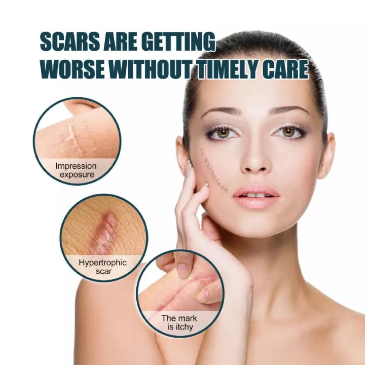1%20Roll%20Silicone%20Gel%20Scar%20Sheet%20Patch%20Treatment%20Removal%20Tape%20Cover%20Burn%20Trauma%20Repair%20Acne%20Ear%20Scar%20Section%20Beauty%20Skin%20-%20Image%203