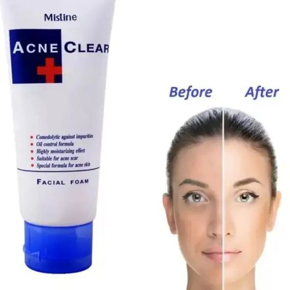 Misline%20Acne%20Clear%20Facial%20Foam%2085ml%20-%20Image%202
