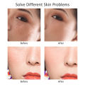 Laser Plasma Pen Black Dots Freckles Mole Wart Remover Pen Dark Spot Remover For Face Electric Pimples Tattoo Skin Tag Removal. 