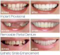 Snap-On Veneers for Instant Smile | Comfortable & Flexible Fit Temporary Dentures | Natural-Looking Cosmetic Teeth Covers for Upper & Lower Teeth | Easy Smile Makeover & Quick Transformation | Affordable Custom Fit Removable Teeth Veneers. 