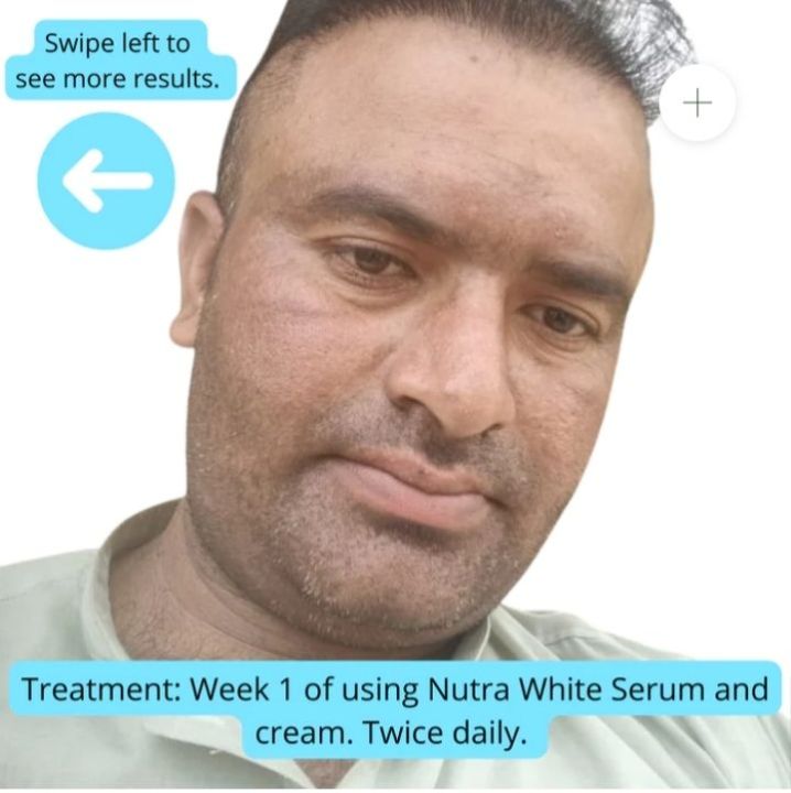 Nutra%20white%20Extreme%20Strong%20Whitening%20Kit%20Glutathione%20Cream%20&%20Serum%20-%20Image%205