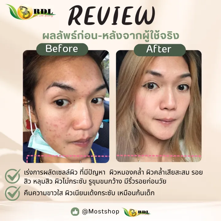 Rdl%20Babyface%20Facial%20Peeling,%20Exfoliating%20Skin%20Cells,%201%202%203%20Large%20Bottles,%20Size%2060%20Ml.%20Genuine%20Product%20from%20the%20Philippines%20-%20Image%208