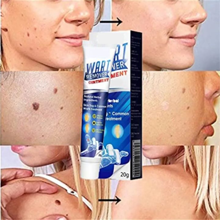 Wart%20Remover%20creaml%20%7C%20Skin%20Tag%20Remover%20cream%20%7C%20massa%20remover%20ointment%20for%20skin%20%7C%20Painless%20Wart%20&%20Skin%20Tag%20Removal%2020g%20-%20Image%202