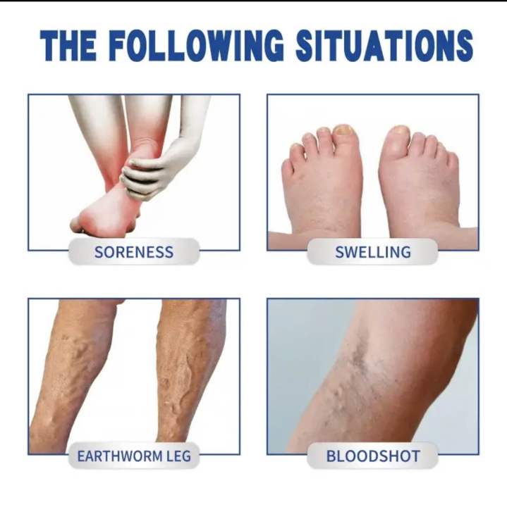 ointment%20for%20varicose%20veins%20Effective%20varicose%20vein%20relief%20cream%20to%20relieve%20Leg%20vasculitis%20phlebitis%20spider%20pain%20swelling%20Care%20-%20Image%204