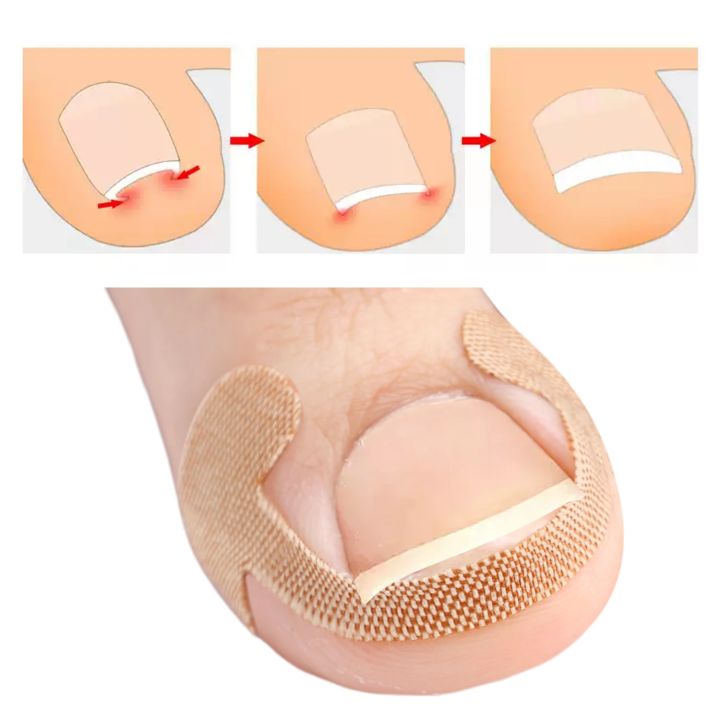 20-100pcs%20Adhesive%20Toenail%20Patch%20Ingrown%20Toe%20Nail%20Correction%20Sticker%20Foot%20Corrector%20Pedicure%20Health%20Care%20Tools%20Toe%20Treatment%20Pad%20freshfeet%20-%20Image%205