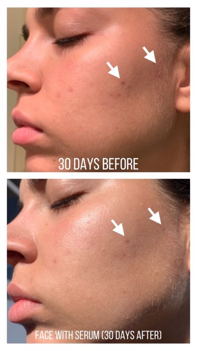 The%20Ordinary%20Niacinamide%20-%20Image%203
