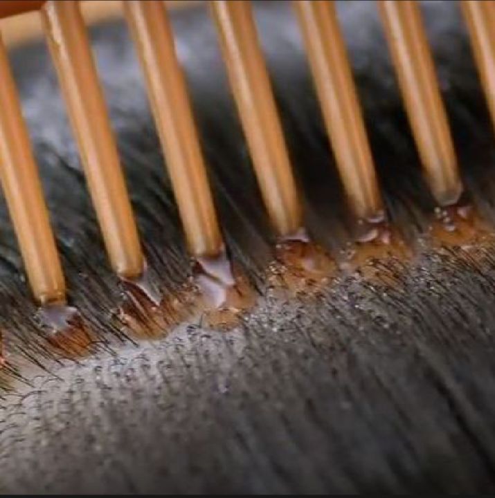 Empty%20Hair%20Oil%20Bottle%20With%20Comb%20%7C%20Best%20For%20Dandruff%20&%20Hair%20Fall%20%7C%20Anti%20Lice%20Comb%20%7C%20Imported%20Multipurpose%20Applicator%20130ml%20-%20Image%203