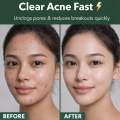 Acne Spot Treatment Serum 30ml.. 