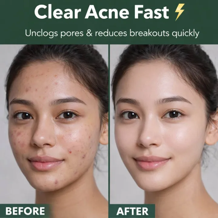 Acne%20Spot%20Treatment%20Serum%2030ml.%20-%20Image%205