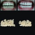70PCS/Package Dental Ultra-Thin Veneers Resin Teeth Upper Anterior Hot.