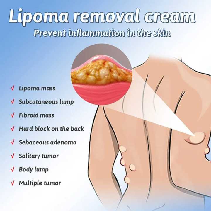 South%20Moon%20Lipoma%20Removal%20&%20Body%20Smoothing%20Cream%20-%2050g%20-%20Herbal%20Natural%20Lump%20&%20Skin%20Knot%20Relief%20Ointment%20for%20Neck%20&%20Body%20-%20Image%203