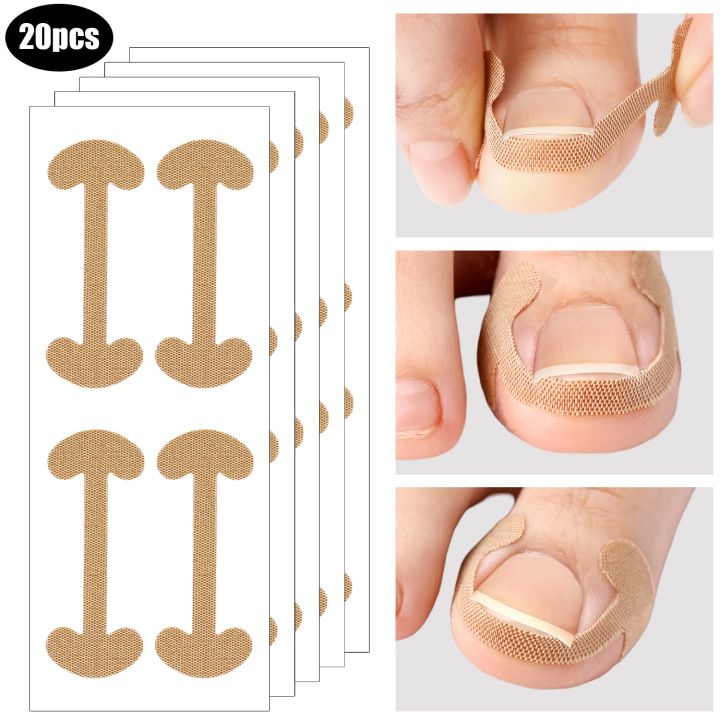 20-100pcs%20Adhesive%20Toenail%20Patch%20Ingrown%20Toe%20Nail%20Correction%20Sticker%20Foot%20Corrector%20Pedicure%20Health%20Care%20Tools%20Toe%20Treatment%20Pad%20freshfeet%20-%20Image%202