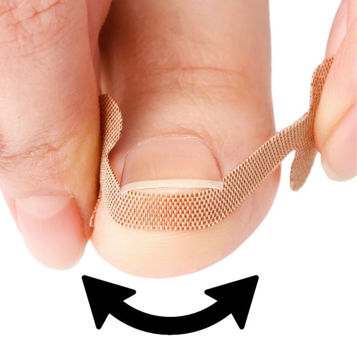 20-100pcs%20Adhesive%20Toenail%20Patch%20Ingrown%20Toe%20Nail%20Correction%20Sticker%20Foot%20Corrector%20Pedicure%20Health%20Care%20Tools%20Toe%20Treatment%20Pad%20freshfeet%20-%20Image%206