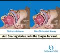 Anti Snoring Mouthpiece Tongue Retainer Helps to Eliminate Snoring Anti Snore Device Silicone Snore Sleep Apnea Anti Ronflement. 