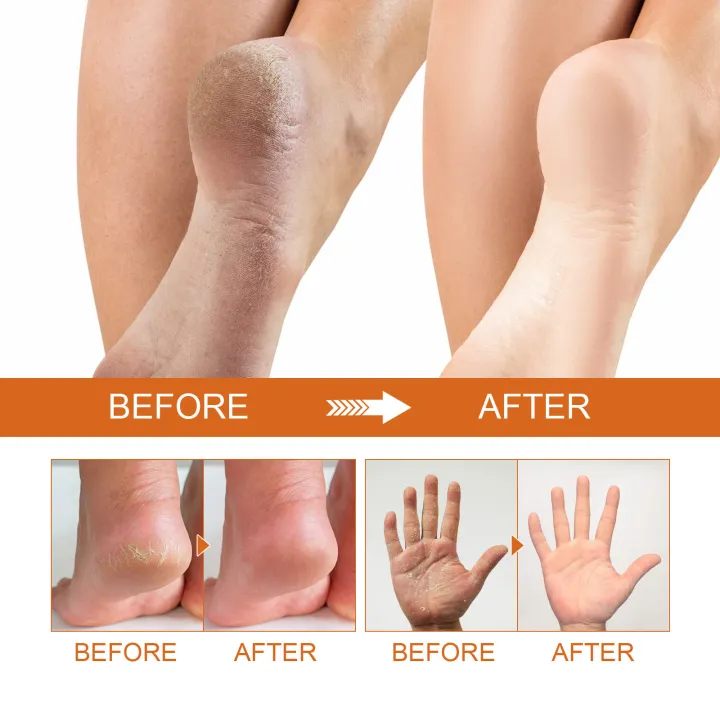 100ml%20Foot%20Peeling%20Spray%20Orange%20Essential%20Oil%20Exfoliating%20Nourish%20Peel%20Feet%20Calluses%20Dead%20Skin%20Remover%20Pedicure%20Foot%20Care%20Tool%20freshfeet%20-%20Image%205
