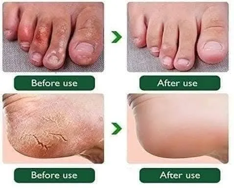Baby%20Foot%20Banana%20Milk%20Cracked%20Heel%20Cream%20-80%20gm%20-%20Image%204