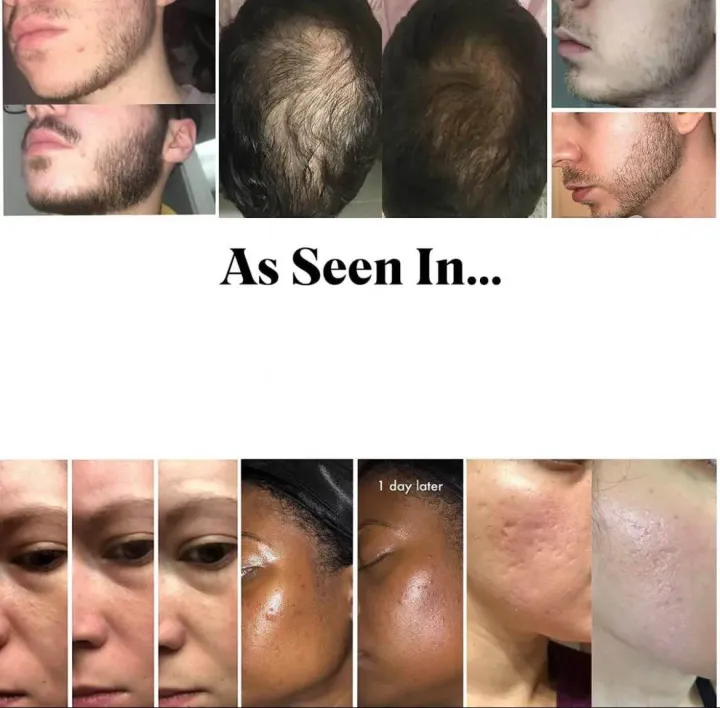 Derma%20Roller%200.5mm%20Original%20%7C%20Titanium%20540%20Titanium%20Microneedle%20for%20Beard%20Growth%20and%20Hair%20Loss%20Treatment%20%7C%20Best%20Quality%20-%20Image%206