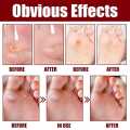 South moon Foot Corn Removal Extra Strengthen Gel 10ml.
